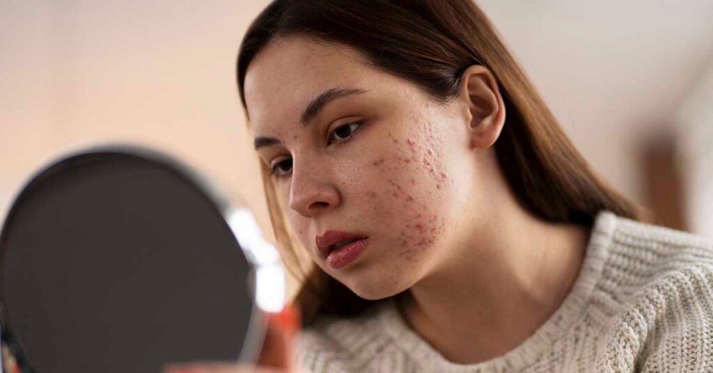 Cicatrizes de acne: como tratar e prevenir