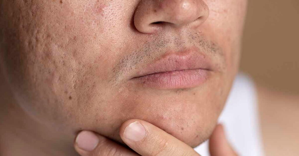 Laser para cicatrizes de acne