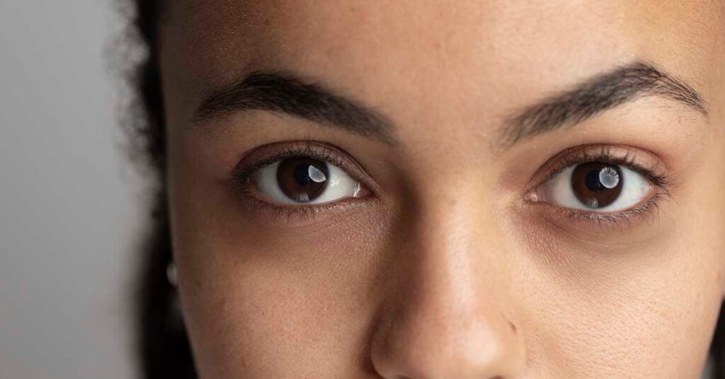 Preenchimento para olheiras: saiba quando usar