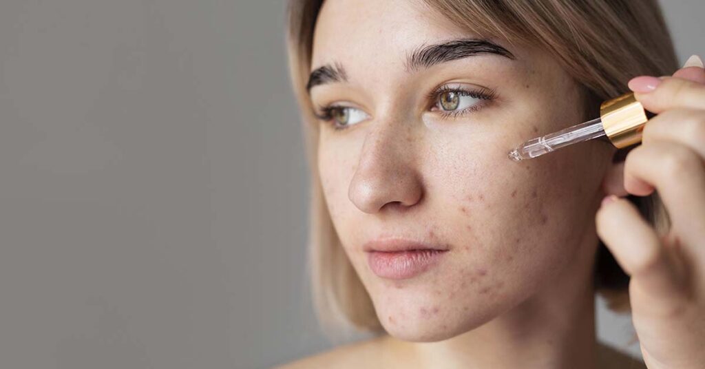Tratamento para acne: conheça as opções