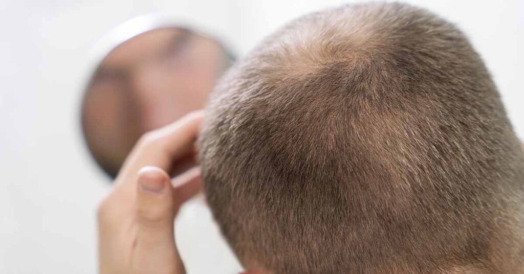 Tratamentos estéticos para queda de cabelo