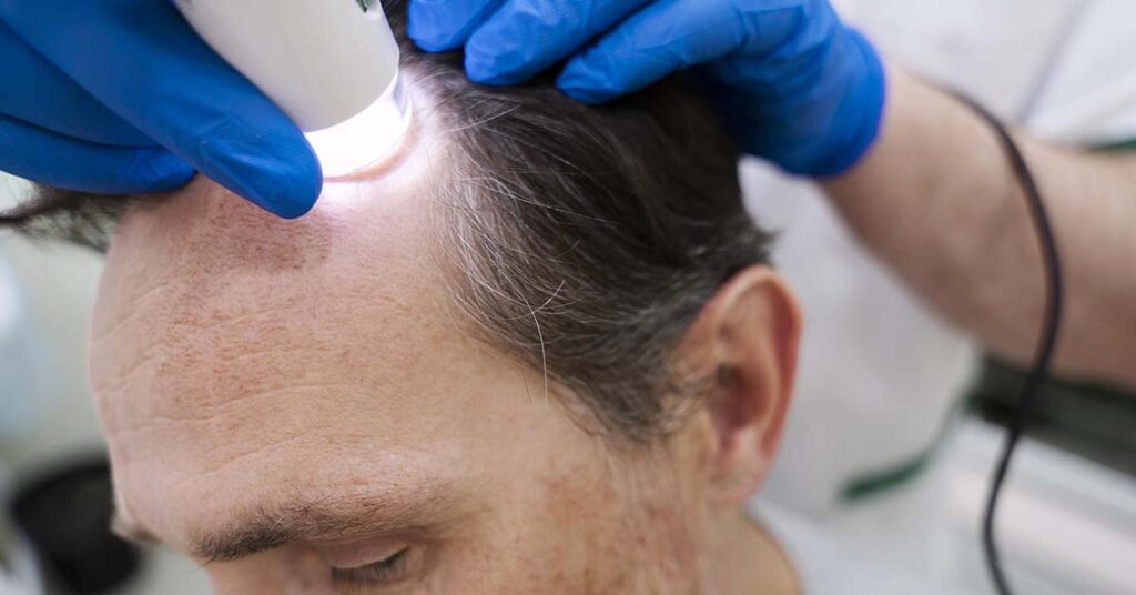 Tipos de alopecia e diferenças